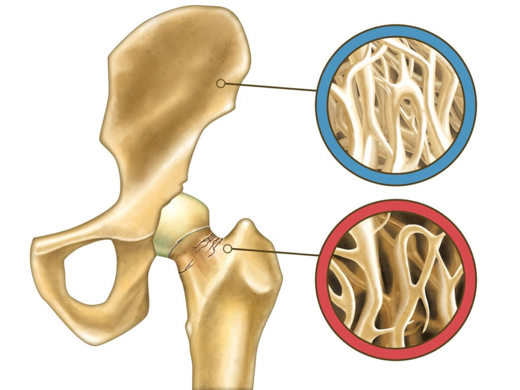 Alimentación equilibrada y ejercicio físico regular frente a la osteoporosis